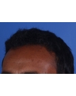 After Hair Transplant&nbsp;Front